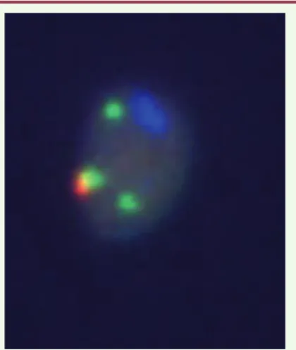 Figure 6. Exemple d’analyse chromosomique in situ par FISH sur  spermatozoïdes de patients porteurs de CCR