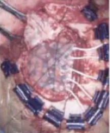 Fig. 5 Invasive method for measuring brain activity [Lecuyer 2007] 