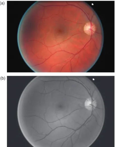 Fig. 3. (a) Closing  B