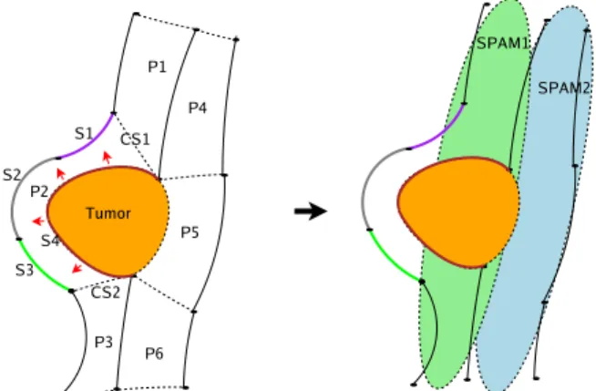 Fig. 8: Let us consider the simplified ROI on the left, where six patches (P1 .. P6) are delimited around the lesion (a tumor, in this case), and two SPAMs SPAM1 and SPAM2 on the right.