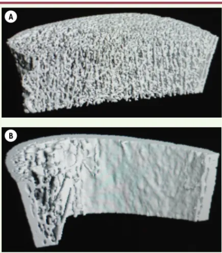 Figure 1. Exemple d’images en HR-pQCT réalisées à 4 cm du  pilon tibial sur deux tibias différents