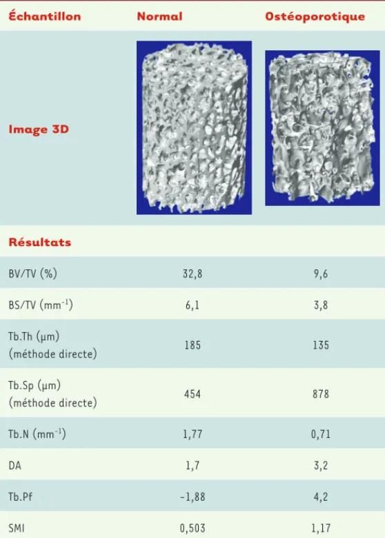 Tableau I. Exemple de résultats sur un os normal et ostéoporotique à partir de  reconstructions 3D réalisées en microCT (résolution 16 μm)