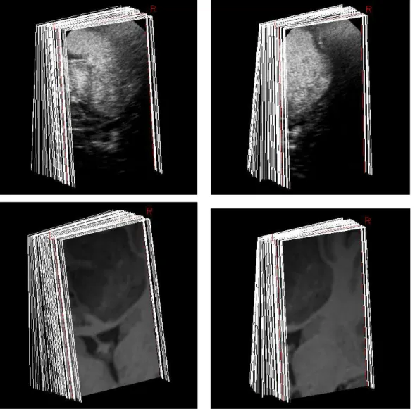 Fig. 5. Top: Intra-operative B-scans sequences of brain used during evaluation. The low-grade glioma and ventricles are visible in white