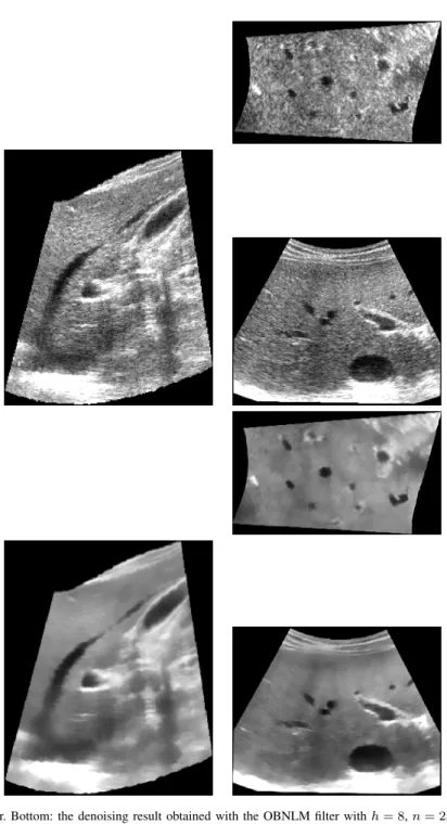 Fig. 6. Top: 3D volume of the liver. Bottom: the denoising result obtained with the OBNLM filter with h = 8, n = 2, α = 1, M = 5 and µ 1 = 0.6.