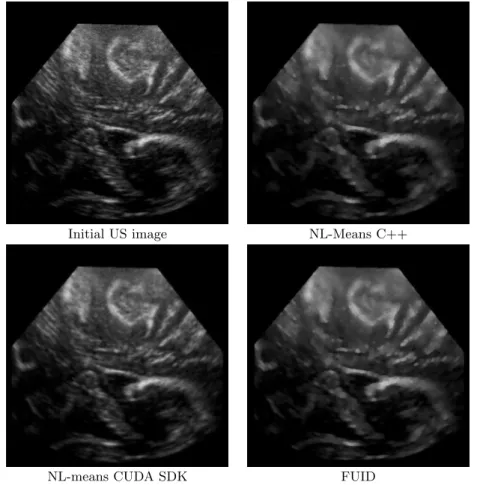 Fig. 3 Qualitative denoising results. A real intraoperative ultrasound was denoised with the three methods