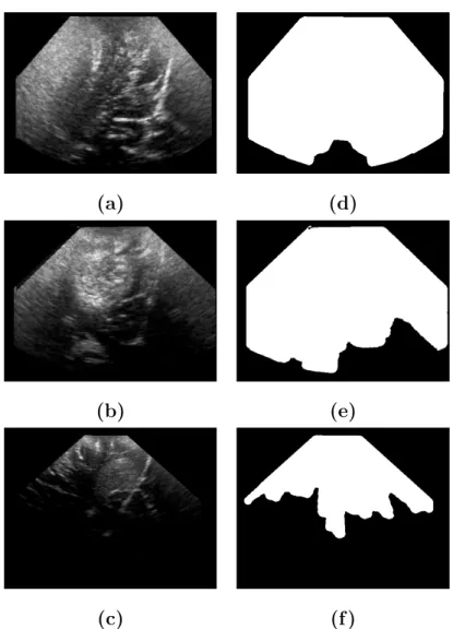 Fig. 7. Left: Real intraoperative data used for the comparison with manual delin- delin-eation