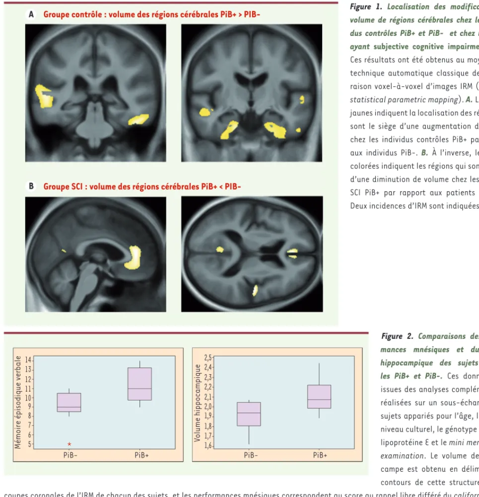 Figure 1. Localisation des modifications de  volume de régions cérébrales chez les  indivi-dus contrôles PiB+ et PiB-  et chez les sujets  ayant  subjective cognitive impairment (SCI)