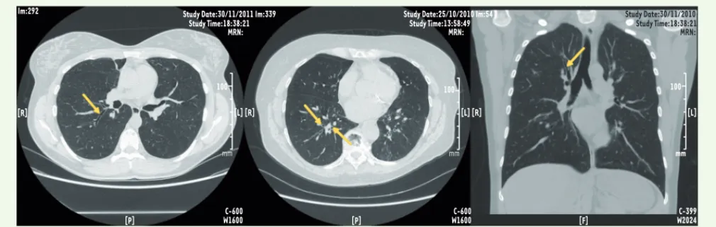 Figure 2. Tomodensitométrie des bronches chez un patient atteint d’asthme. Les parois des bronches apparaissent épaissies en coupe transversale  ou en coupe longitudinale (marquées par une flèche).
