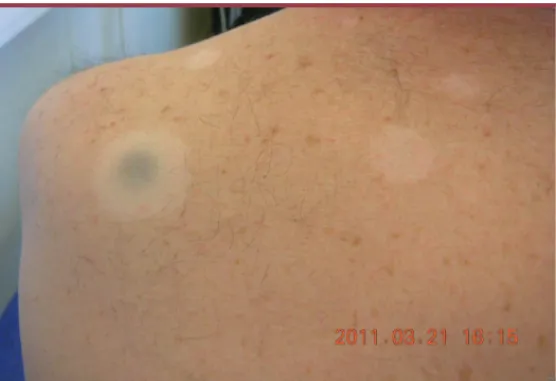Figure 1. Lésions dépigmentées vitiligoïdes autour des métastases cutanées de  mélanome chez un patient traité par ipilimumab et ayant une réponse  thérapeu-tique depuis plus de deux ans.