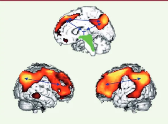 Figure 2.  Dysfonctionnement métabolique. Le dysfonctionne- dysfonctionne-ment (dû à une atteinte corticale directe ou à une déconnexion  cortico-corticale ou thalamo-corticale) du circuit  fronto-parié-tal concerne les aires médianes et préfronfronto-pari