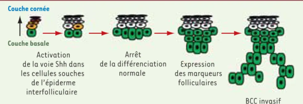 Figure 2. Modèle d’initiation du BCC chez la souris  adulte. L’activation de la voie Hedgehog dans les  cellules souches de l’épiderme entraîne un arrêt de  leur différenciation normale, induit l’expression de  marqueurs du follicule pileux et finalement c