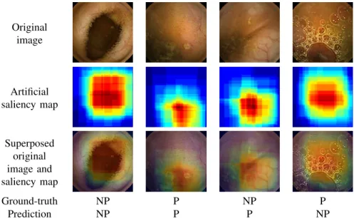 Fig. 2. Examples of artificial saliency maps according to the detection result (with P for the pathological class and NP for the non-pathological one).