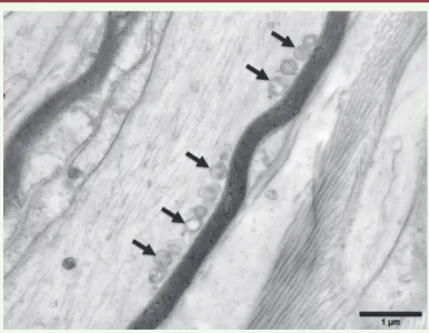 Figure 2.  Biopsie nerveuse d’un patient atteint de CMT2A2 (mutation  de MFN2). Micrographie électronique, section longitudinale