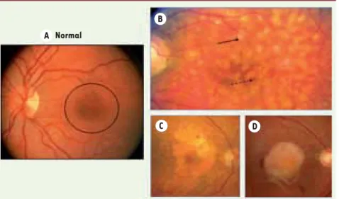 Figure 1.  Différents aspects de la DMLA au  fond d’œil. A. Fond d’œil normal : la macula  est entourée d’un cercle noir
