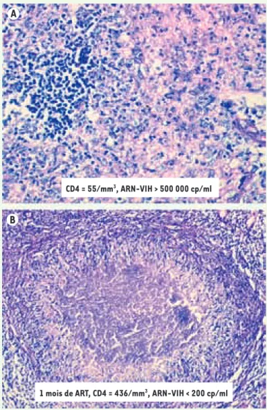 Figure 1.  Aspect anatomopathologique de la reconstitution  immune fonctionelle lors d’un IRIS lié à Histoplasma  capsu-latum chez un patient infecté par le VIH après ART