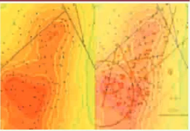 Figure 19.  Distribution du logarithme des durées de séjour  (logDS) de patients du GHM 106, intitulé « Autres diagnostics  portant sur les oreilles, le nez, la gorge ou la bouche, âge  supérieur à 17 ans ».
