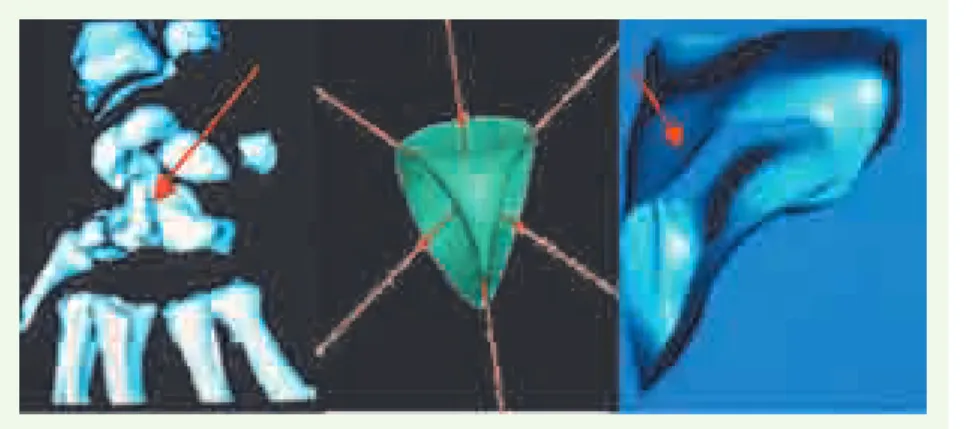 Figure 20. Points singuliers de Withney d’une  surface, présents sur les os du poignet (grand  os à gauche), sur la surface de Steiner (au  cen-tre) et sur le noyau gris central VIM (ventralis  intermedius nucleus), permettant la mise en  correspondance da