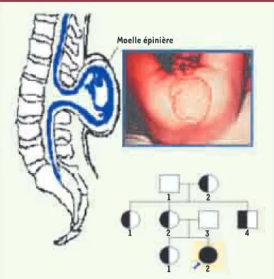 Figure 10.  Applications de la biologie des systèmes en géné- géné-tique médicale. Exemple de dysgenèse, la spina bifida, avec  l’arbre généalogique du patient (noir), les porteurs sains  des gènes pathologiques (noir et blanc) et les non-porteurs  (blanc)