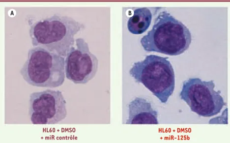 Figure 2. Blocage de la différenciation mono- mono-cytaire des cellules de la lignée HL60 induit  par la surexpression de miR-125b
