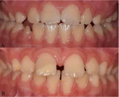 Figure 2. Intra-oral photographs of two cases of tooth discoloration.   