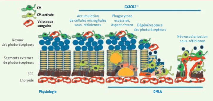 Figure 2. Rôle des CM dans la DMLA. Dans la rétine normale, les CM se situent au niveau de la rétine interne et n’interviennent qu’occasionnellement  dans le recyclage et l’élimination journalière des segments externes des photorécepteurs