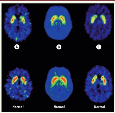 Figure 1. Imagerie cérébrale par PET scan montrant le nucleus accumbens  (zone rouge indiquant les récepteurs de la dopamine) chez des individus  soumis à un stress de récompense (d’après  [9])