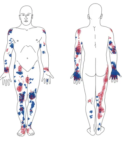 Figure  6  -  Superposition  schématique  et  analyse  de  la  densité  du  noyau  des  ecchymoses  et  abrasions chez les victimes d’homicide par strangulation 