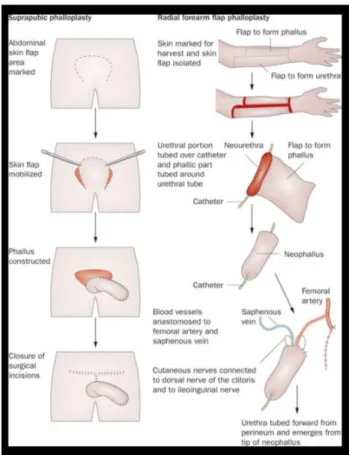 Fig. 11: Phalloplasty - ‘Gender Reassignment Surgery, an Overview’, in Urology, (8), 2011.