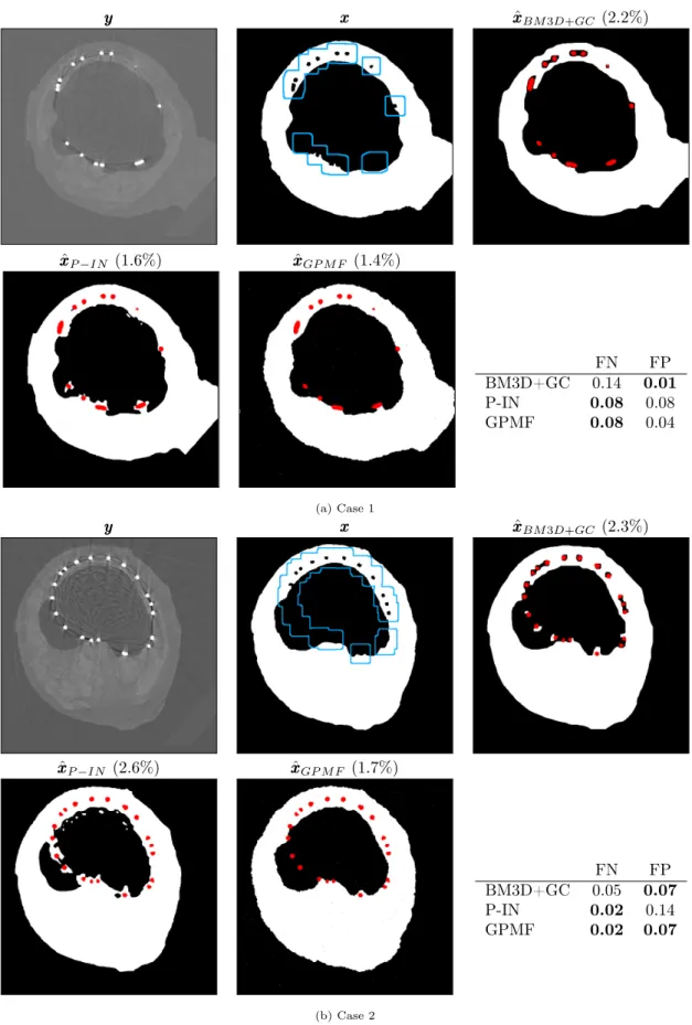 Figure 5: Unsupervised segmentations of organic material in corrupted X-rays images. For these 2 cases, which illustrate different explanted biomaterials, we have: the real image yy y, the ground truth image xx x, the BM3D-GC segmentation, the P-IN segment