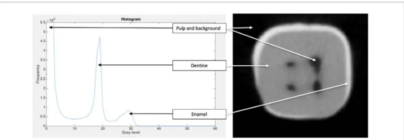 Figure 2.  Histogram of the CBCT lower molar volume. On the left, the plot of the histogram presents three classes corresponding to  the three anatomical structures of the tooth (enamel, dentine and pulp)
