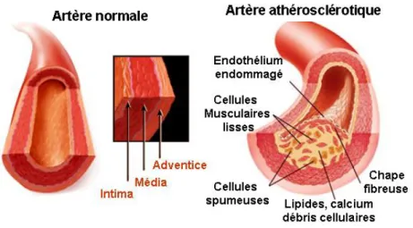 Figure 1. Structure de la paroi artérielle normale et athérosclérotique (figure  traduite de Encyclopaedia Britannica)