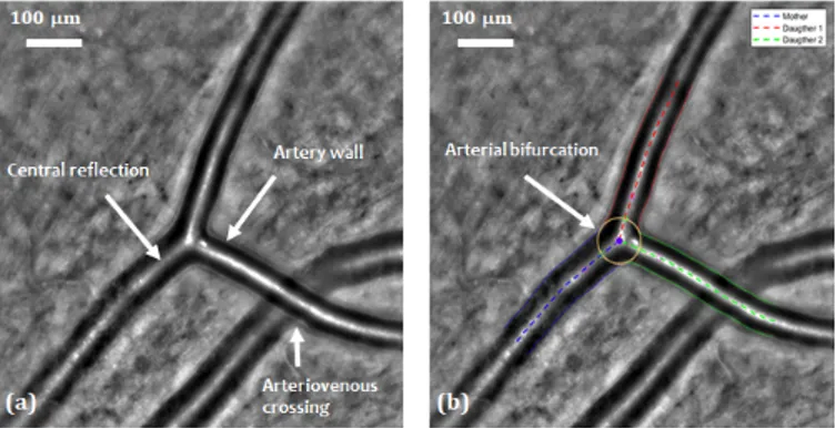 Fig. 1: AOO image. (a) Retinal arterial bifurcation and arte- arte-riovenous crossing