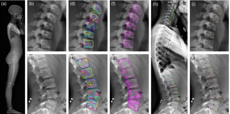 Figure 7 Visual illustrations of the processing steps: (a) Original sagittal X-ray (EOS™); (b-c) Enhanced images in cervical and lumbar  regions;  (d-e)  Simplified  edge  segments  plotted  on  cervical  and  lumbar  regions;  (f-g)  Corner  point  candid