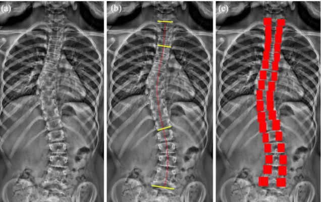 Fig. 1    2D statistical shape modeling. a Original frontal radiograph  image.  b Manually identified spinal line and four vertebral  end-plates: the upper endplates of T1 and T4 and lower endplates of T12 