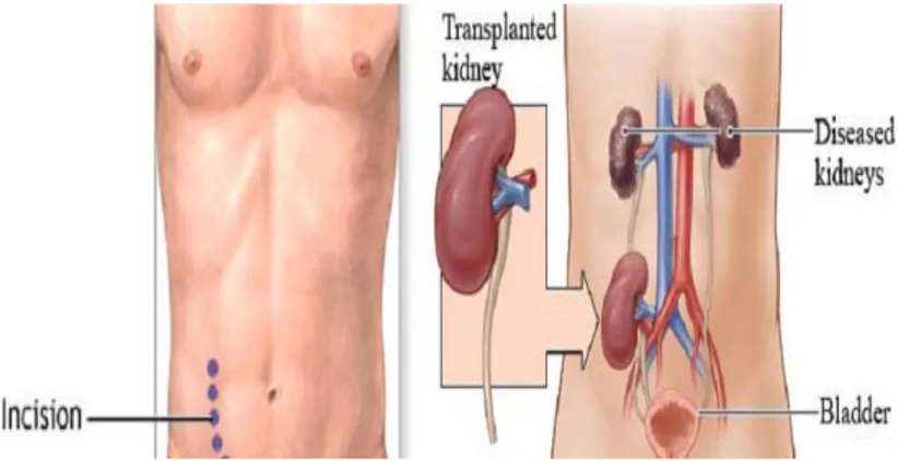 Figure 03: kidney transplant anatomy (Mark, 2013) 