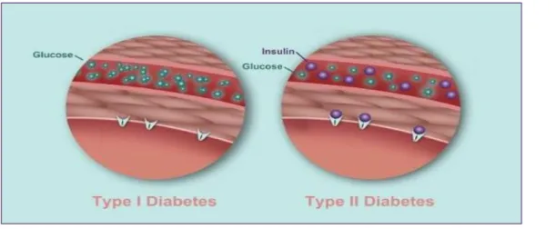 Figure 01 : Difference between diabetes type I and II (Chris  , 2017). 