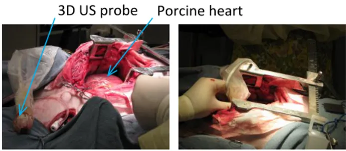 Fig. 3. Beating-heart intracardiac surgery with 3DUS probe manually positioned on the epicardial surface.