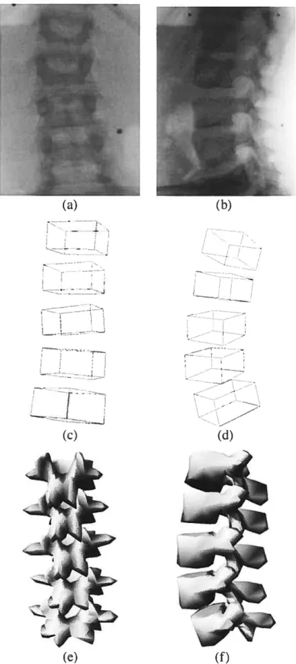 FIG. 2.9 — Exemple de reconstruction obtenue à partir de deux radiographies.