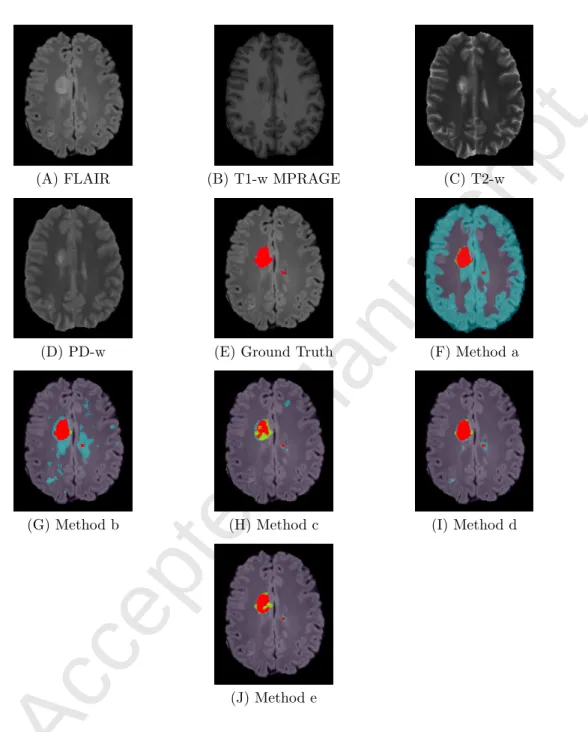 Figure 4: Comparison of MS lesion classification methods, example 2 - patient 4, slice 153