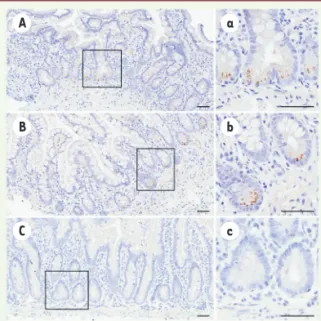 Figure 2. Détection de l’anti- l’anti-gène de capside du virus de  l’hépatite E (HEV) dans les  entérocytes d’une patiente  chroniquement infectée par ce  virus