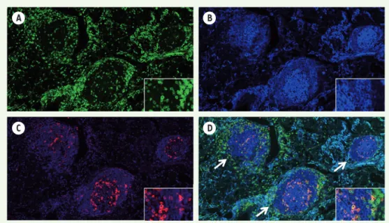 Figure 1. Présence de structures lym- lym-phoïdes tertiaires dans les tumeurs  pulmonaires humaines