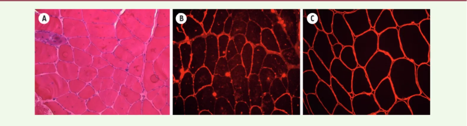 Figure 4. Biopsie musculaire. On observe un aspect dystrophique des fibres musculaires caractérisé par une variation de taille des fibres et une  augmentation du tissu conjonctif en H&amp;E (A)