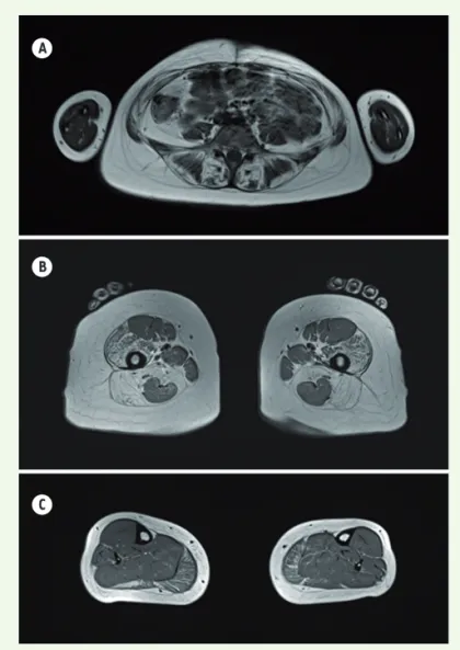 Figure 5. IRM musculaire. On observe une atrophie graisseuse des muscles para- para-vertébraux (A)