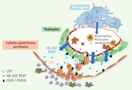 Figure 1. Recrutement pathogénique des cellules épithéliales pariétales vers le capillaire glomé- glomé-rulaire au cours des glomérulonéphrites extracapillaires « à croissants » (GNEC) et de la  hyali-nose segmentaire et focale (HSF)