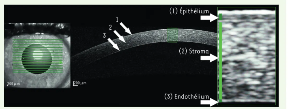 Figure 2.  Coupe d’une cornée  réalisée avec un dispositif  d’imagerie AS-OCT. On distingue  l’épithélium en surface (1), le  stroma (2) et la couche  endo-théliale (3) de la cornée.