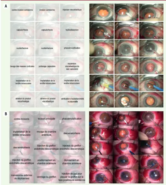 Figure 4. A. Les différentes étapes chirur- chirur-gicales de l’intervention de cataracte par  phacoémulsification sont stéréotypées  (Encadré)