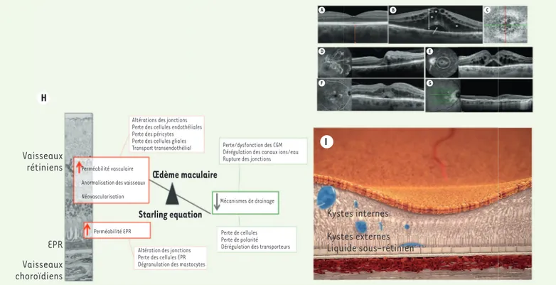 Figure 2. Œdèmes maculaires : mécanismes et formes cliniques. A-G. Images de formes cliniques d’œdèmes maculaires (OM) en tomographie à 