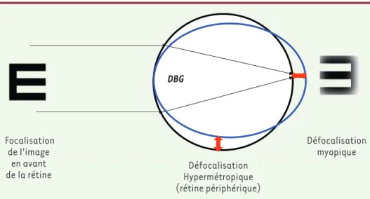 Figure 1. Physiopathologie de l’œil myope ;  effets sur le globe oculaire.