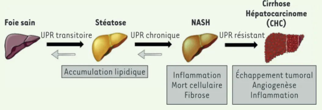 Figure 1. Les complications hépatiques  associées à l’obésité. Le foie sain peut  évoluer vers la stéatose, un stade bénin,  caractérisée par une accumulation de  lipides