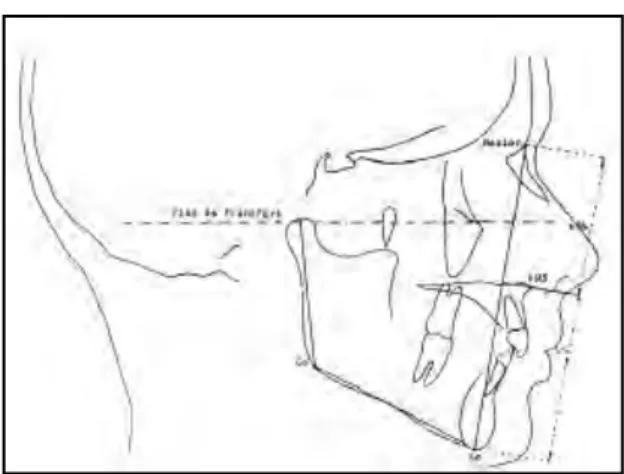 Figure 26 : Rapport de Wylie (15)(d’après Müller) 